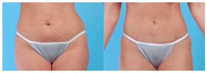 Liposuction / Mini Tummy Tuck  Otolaryngology & Facial Plastic