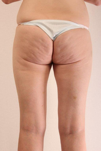 Cellfina Cellulite Reduction Before and After 02