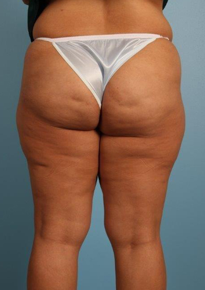 Cellfina Cellulite Reduction Before and After 08