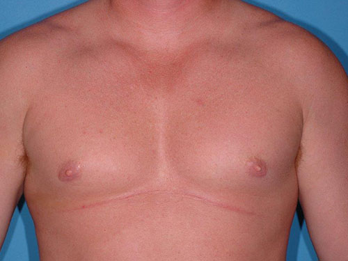 Gynecomastia Before and After 02